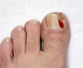 Ingrown Toenails Treatment  Foot Doctor Saint George, UT 84770