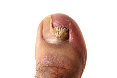 Toenail Fungus Can Cause Nail Damage